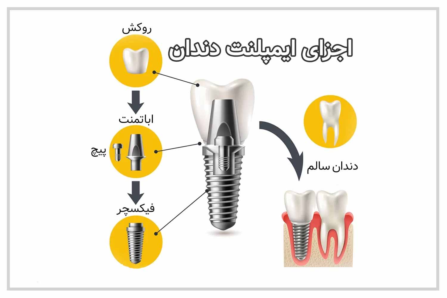 اجزای ایمپلنت دندان